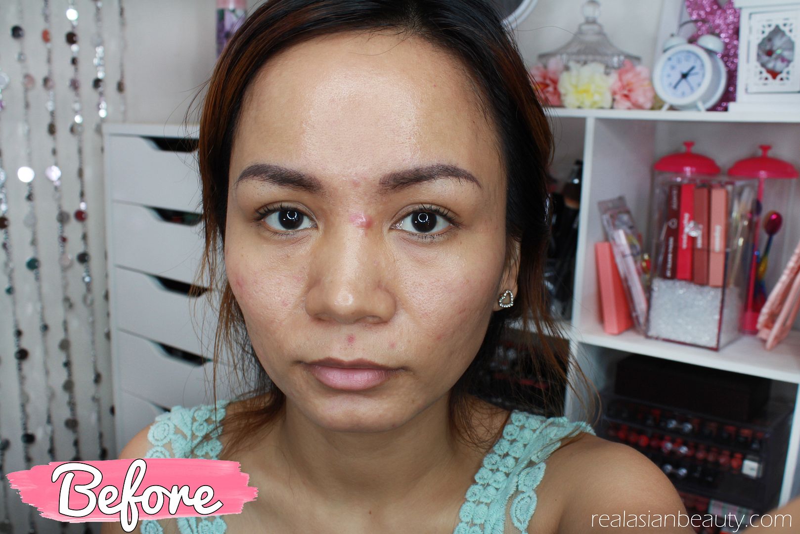Real Asian Beauty MYRA Vitamin E Benefits on ACNE Prone Skin